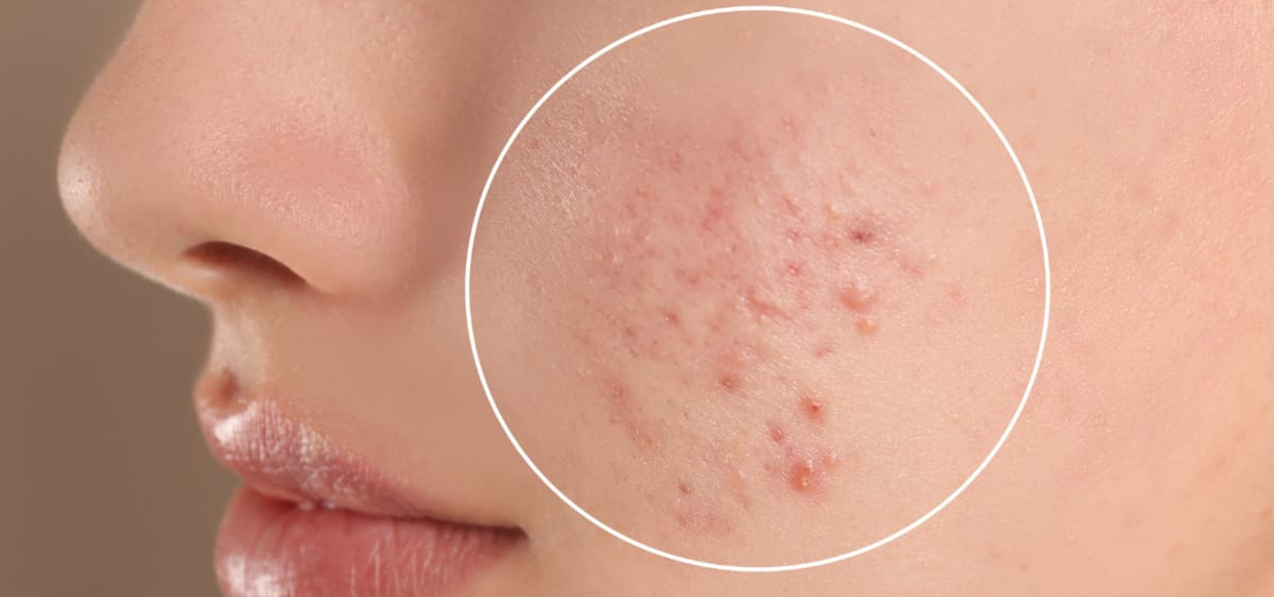 Acne Treatment in Rajajinagar