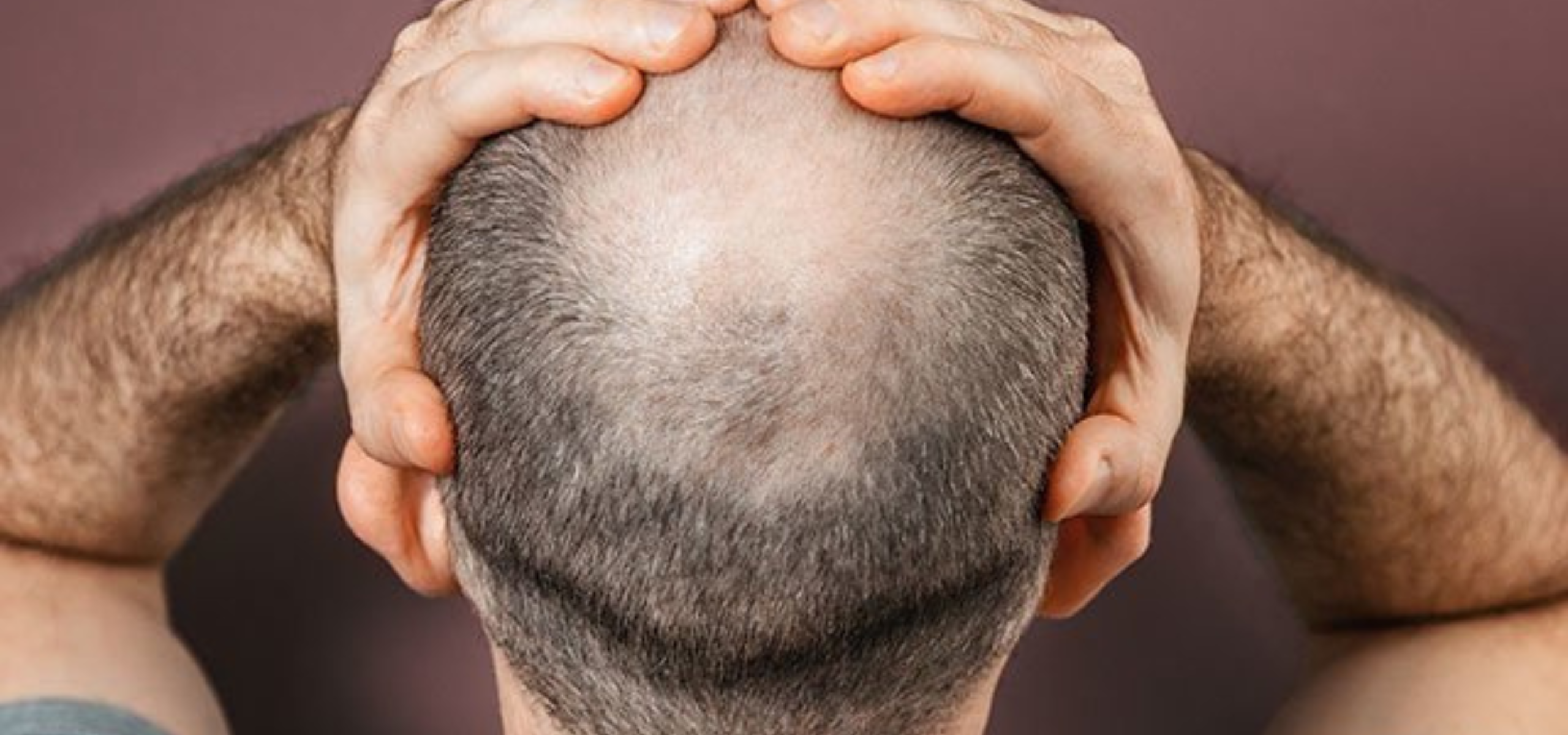Baldness Treatment in Rajajinagar