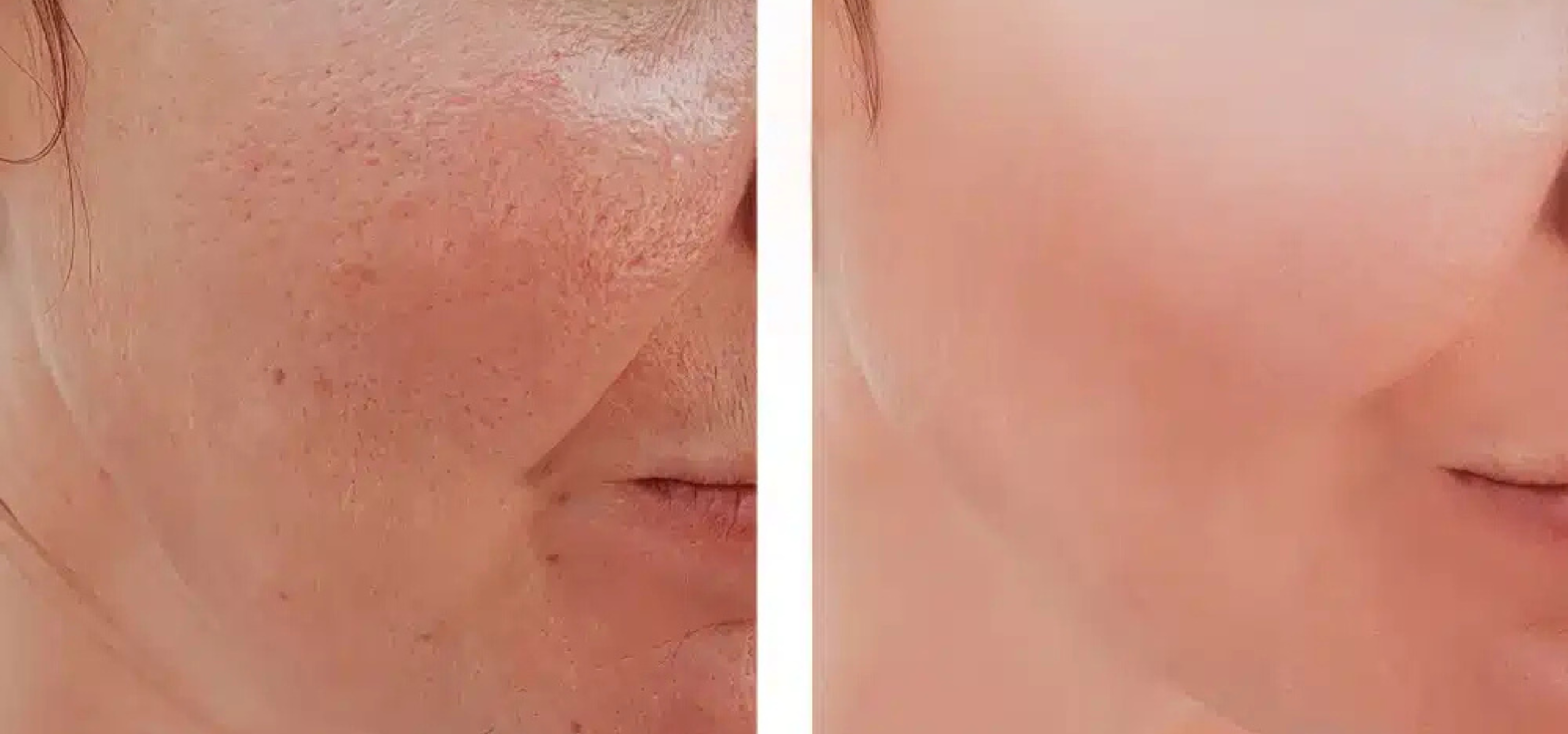 Fractional Laser Treatment in Rajajinagar