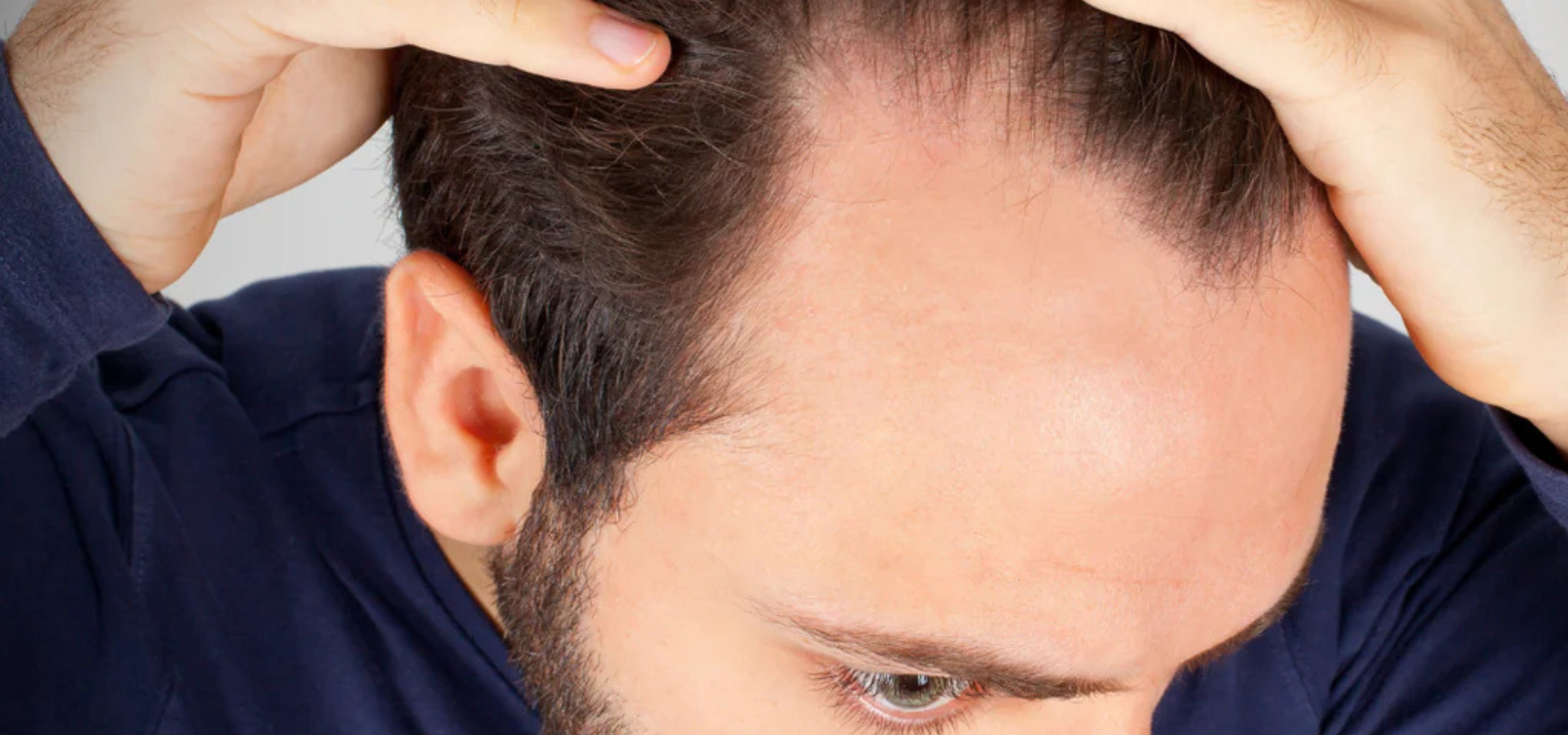 Hairfall Treatment in Rajajinagar