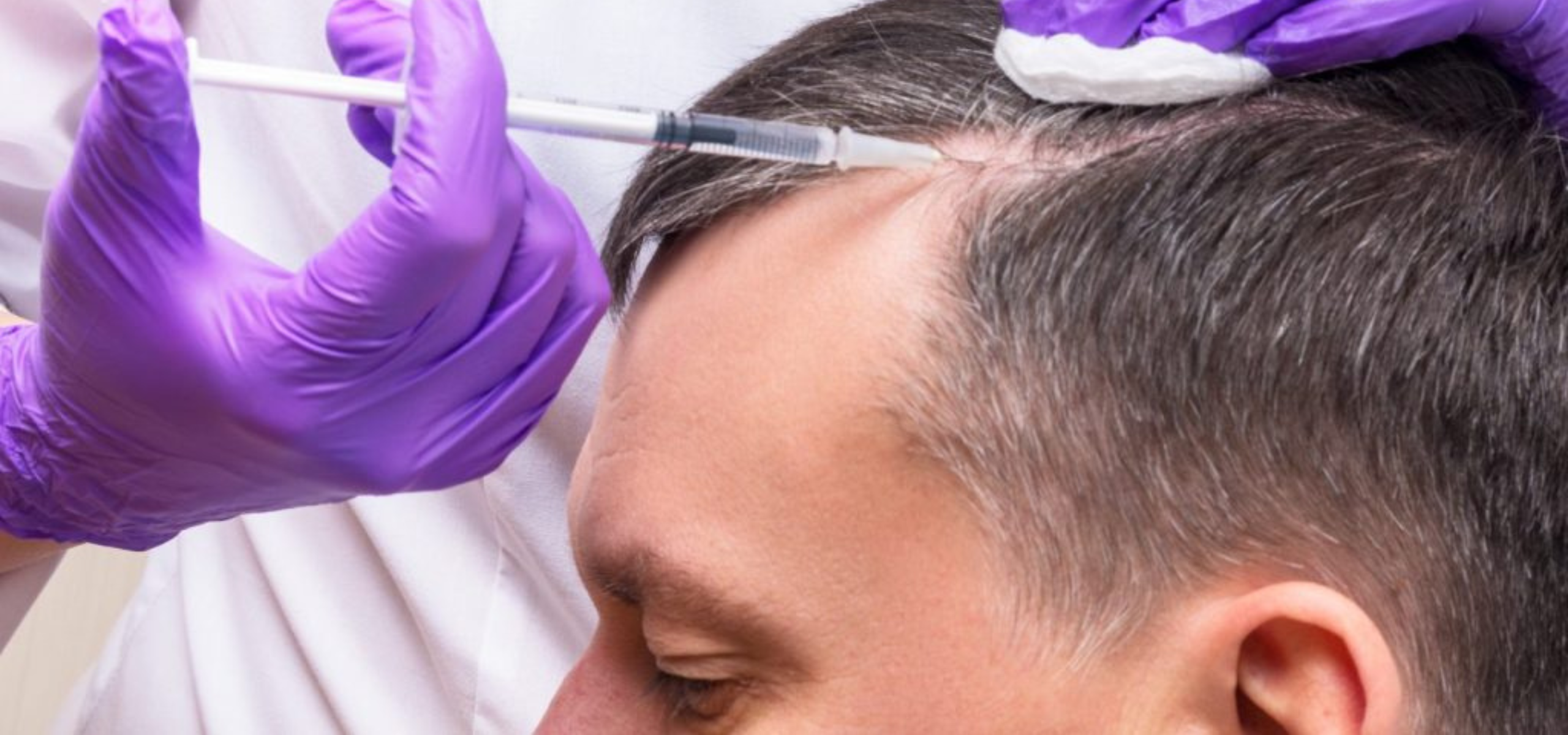 PRP for Hair Treatment in Rajajinagar