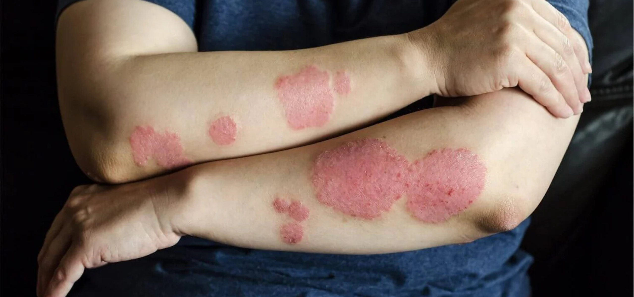 Psoriasis Treatment in Rajajinagar