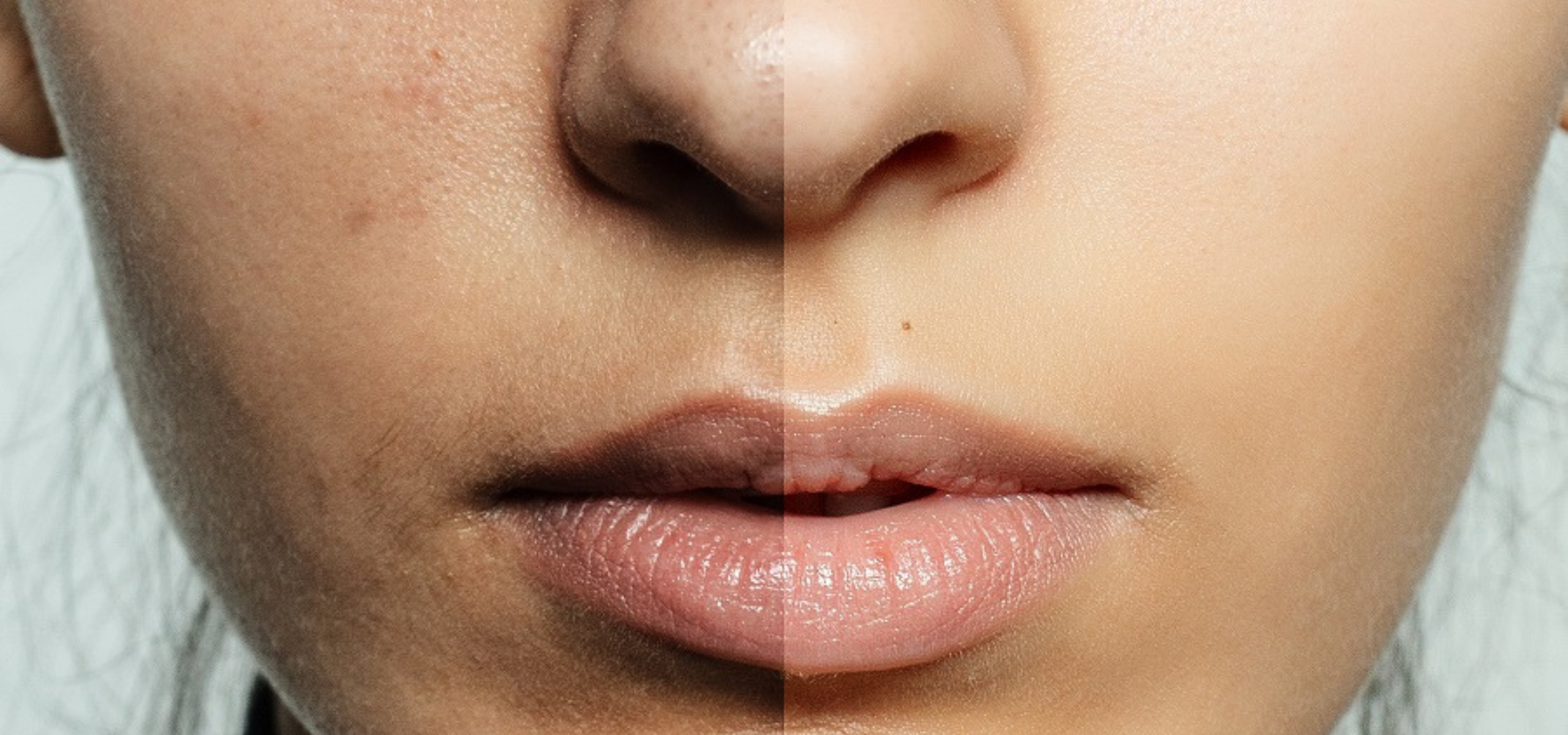 Skin Pigmentation Treatment in Rajajinagar