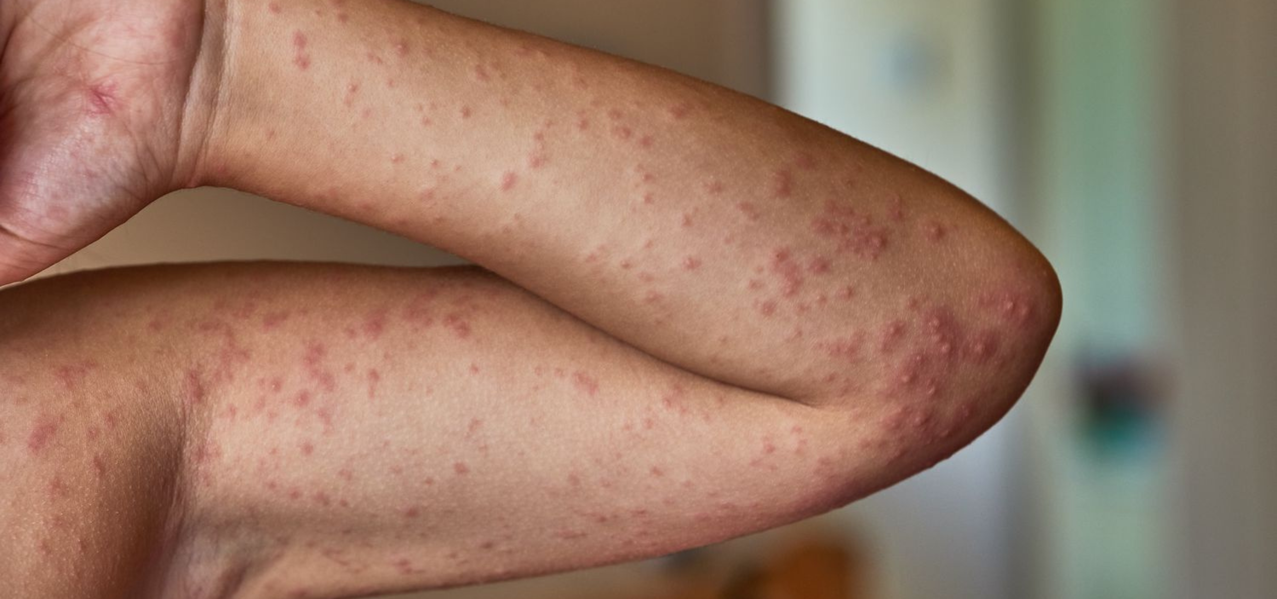 Urticaria Treatment in Rajajinagar