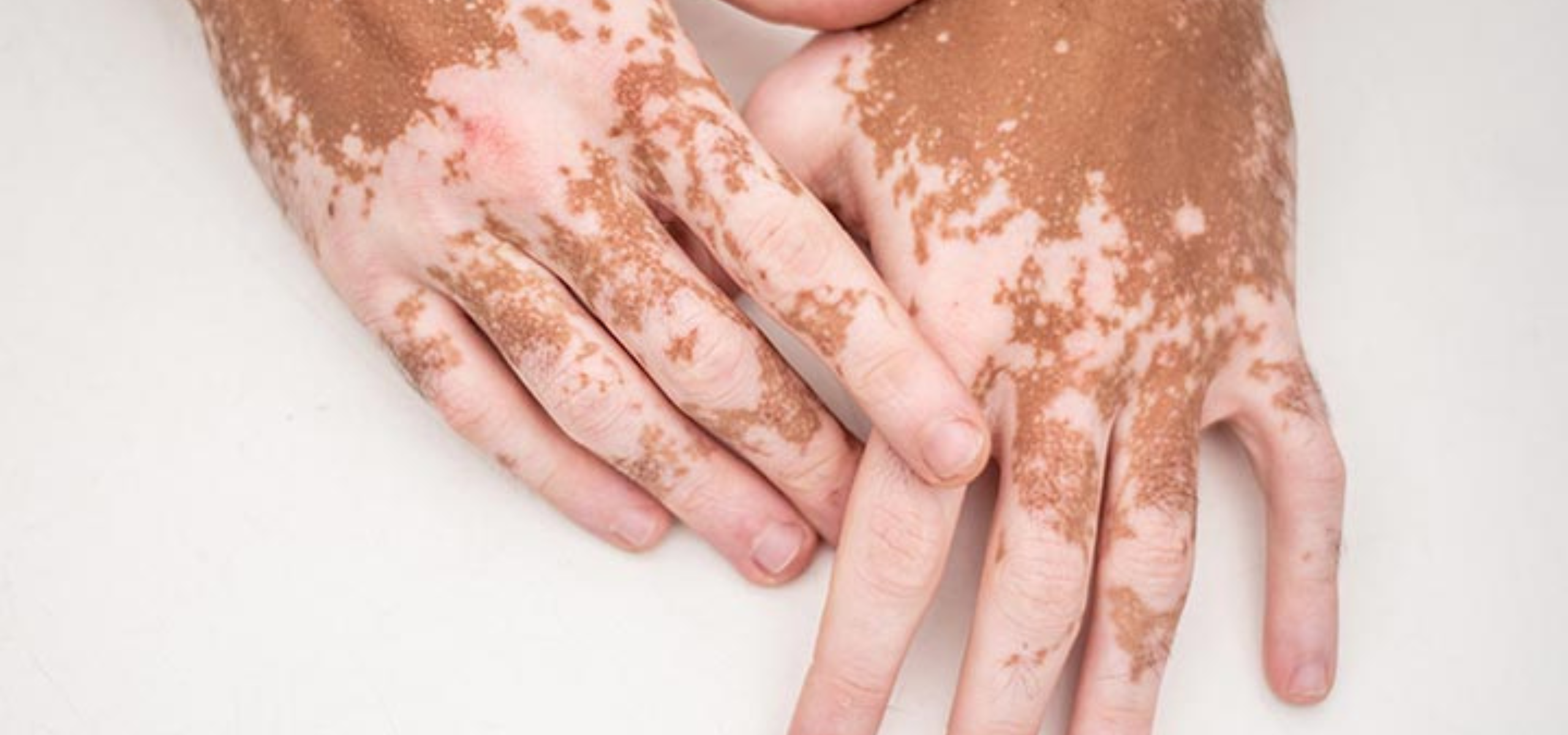 Vitiligo Treatment in Rajajinagar