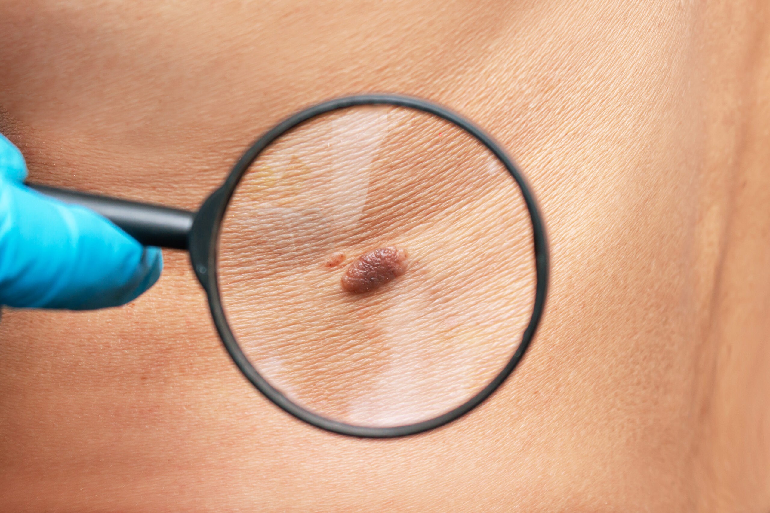 Keloid Treatment in Rajajinar