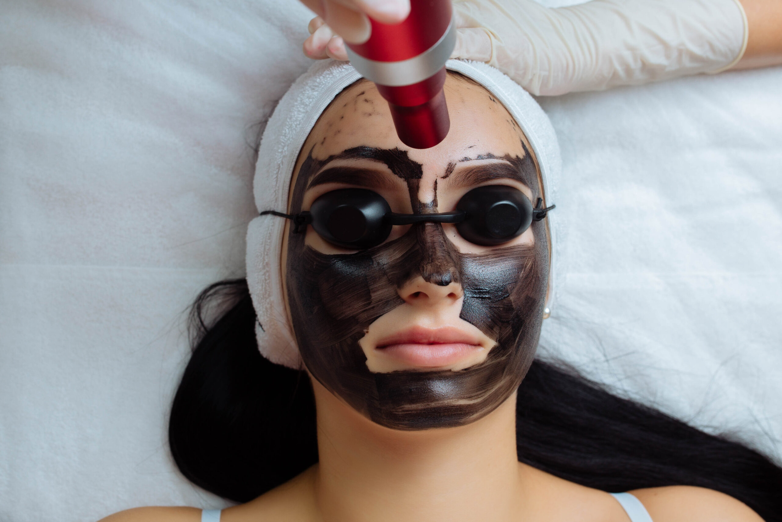 Carbon Facial Treatment in Rajajinagar