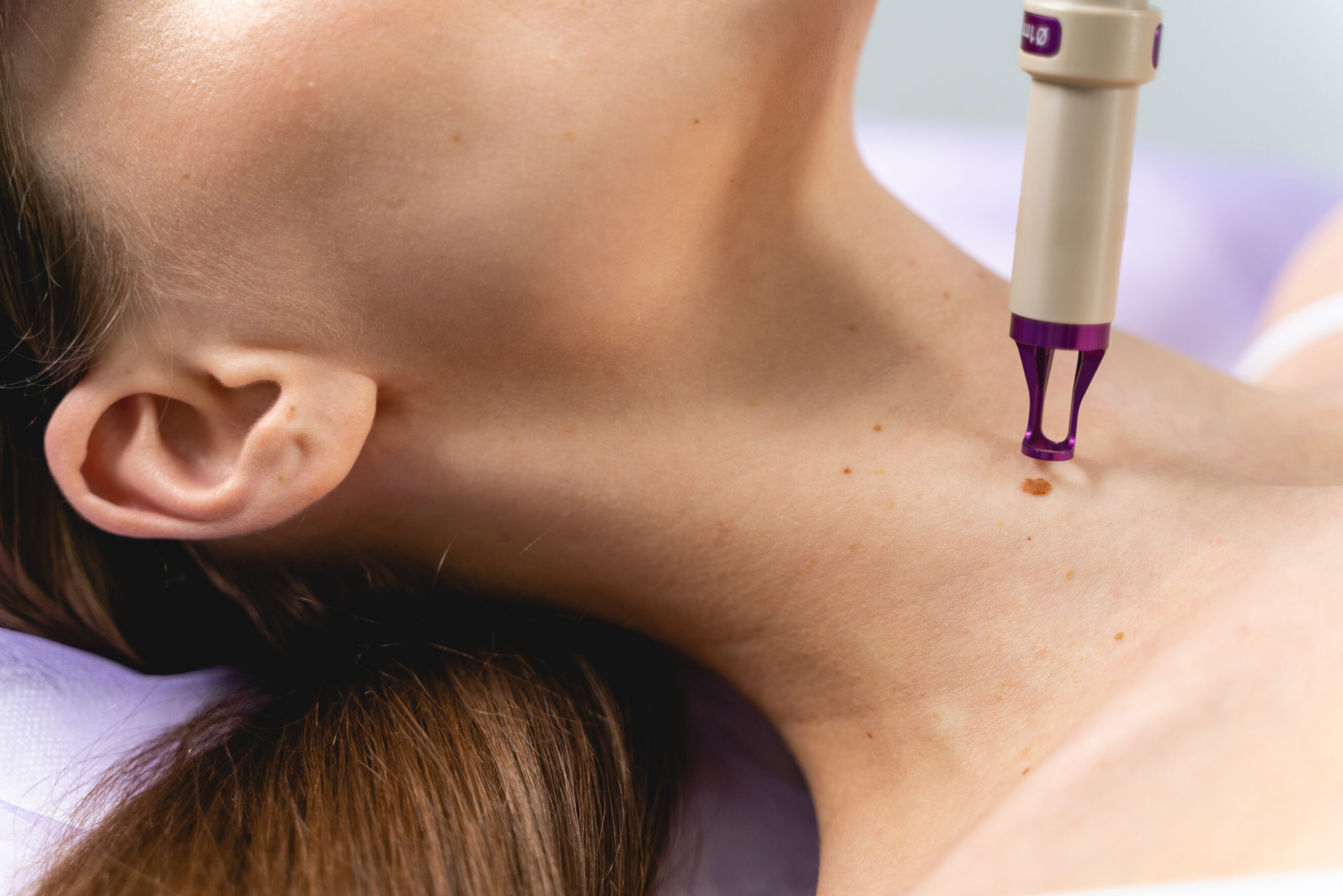 Skin Tag Removal Treatment in Rajajinagar